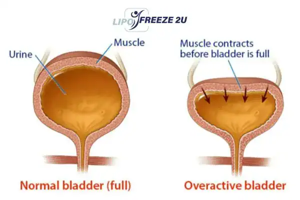 diagram of overactive bladder treatment Birmingham