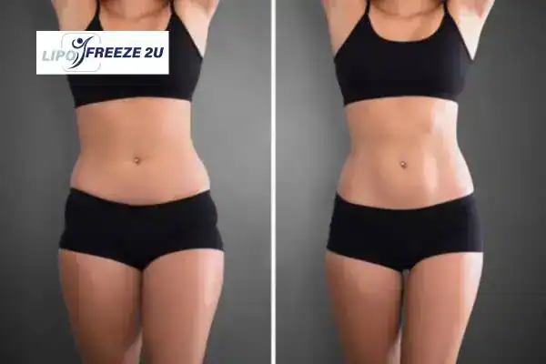 How Can LIPO FREEZE 2U Support Your Post-Pregnancy Body Recovery Birmingham?