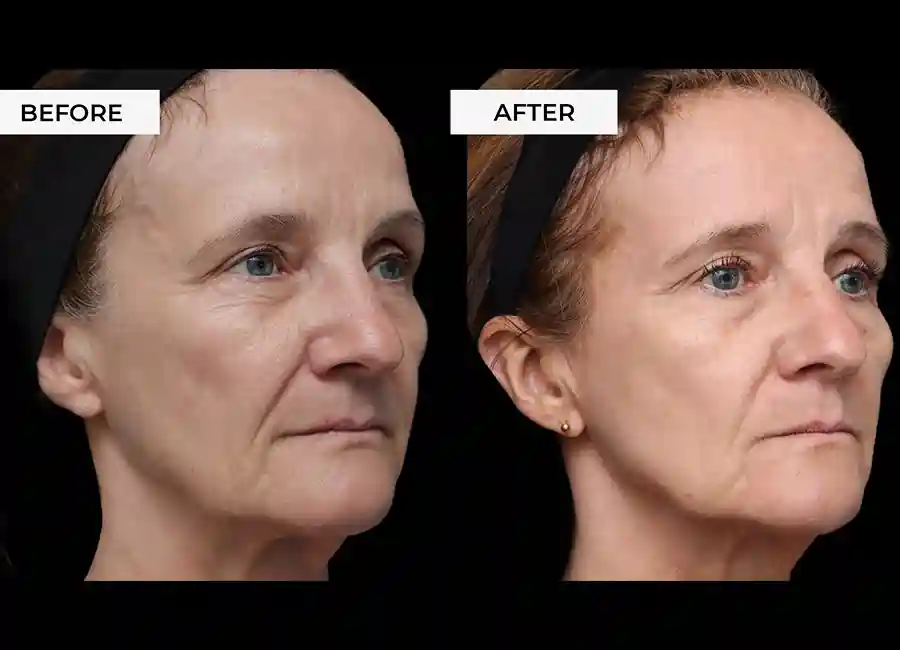 How Many RF Microneedling Sessions Will You Need to See a Difference Birmingham?