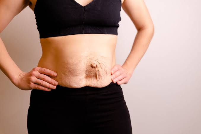 Is Surgery Really the Only Way to Repair Diastasis Recti Birmingham?