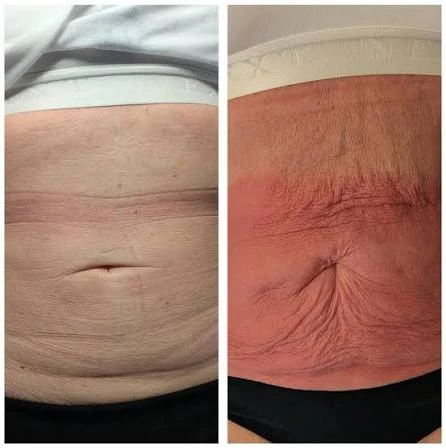 How Does RF Microneedling Improve Crepey, Thin and Uneven Skin Texture Birmingham?