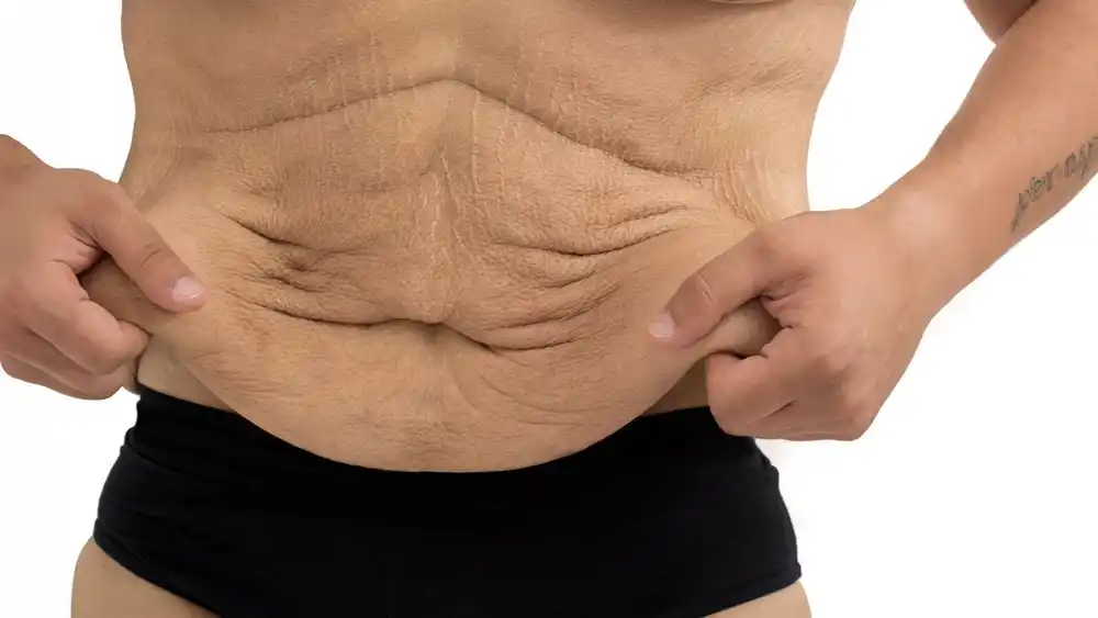 Why Does Weight Loss Medication Leave Some People With Loose or Sagging Skin Birmingham?